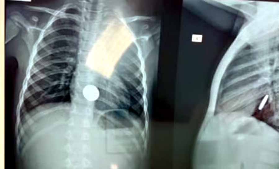 Menino de 5 anos engole moeda de 50 centavos e passa por cirurgia em hospital no Acre